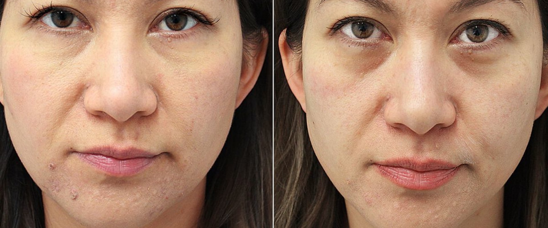 are-under-eye-fillers-worth-it