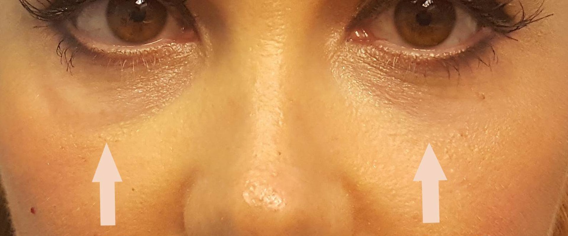 does filler get rid of under eye wrinkles